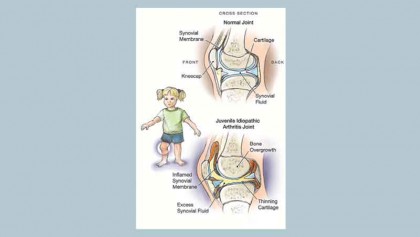 Juvenile rheumatoid arthritis and occupational therapy
