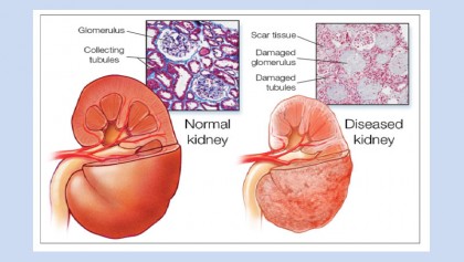 ‘16pc people suffer from kidney diseases for adulterated food intake’