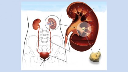 Kidney stones