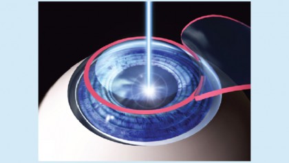 Lasik eye surgery