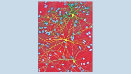 Major cause of dementia discovered