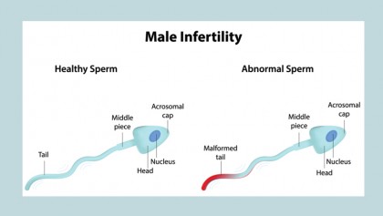 Male infertility