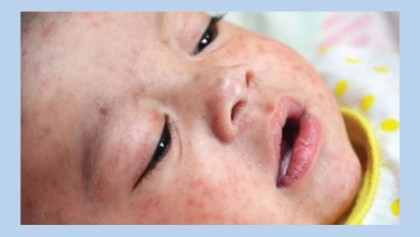 Measles outbreak declared in Philippines