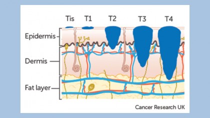 Melanoma stages: Prognosis, survival rates and treatment