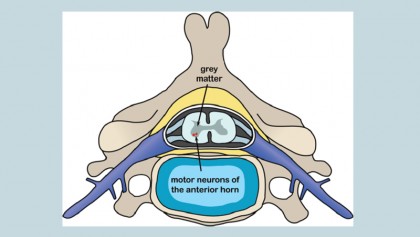Occupational therapy for motor neuron disease