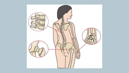 Osteoporosis