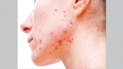 Pain of acne more 
than skin deep
