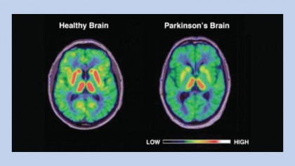 Parkinson's disease symptoms, causes, stages, treatment, and life expectancy