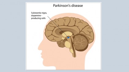 Parkinson’s disease: cause and effect