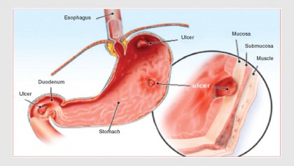 Peptic Ulcer Diseases