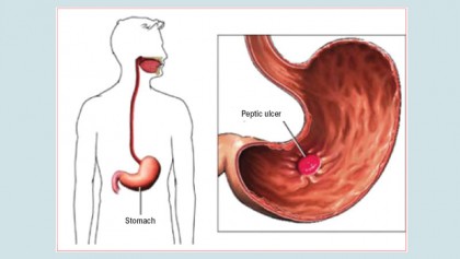 Peptic ulcer diseases