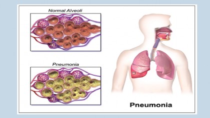 Pneumonia claims the lives of the world’s most vulnerable children