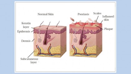 Psoriasis and beyond 