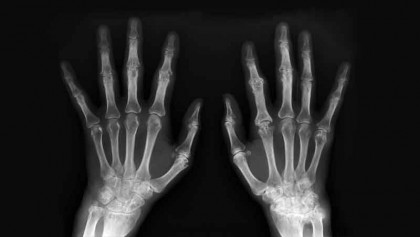 Rheumatoid and musculoskeletal diseases (RMDs)