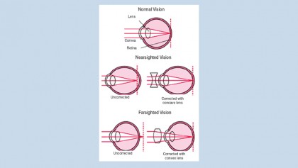 Refractive disorders
