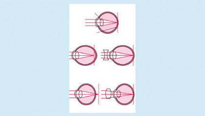 Refractive disorders