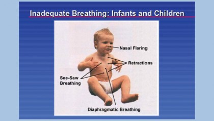 Respiratory emergencies in children
