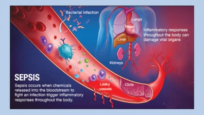 Sepsis: Everything you need to know
