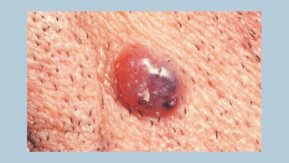 Skin cancer: A visual guide to identifying warning signs on your body