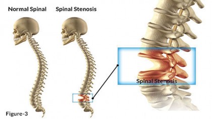 Spinal Stenosis 