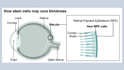 Stem cell trial aims to cure blindness