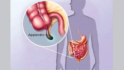 Surgery or antibiotics 
for appendicitis? 
