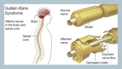 Guillain-Barré Syndrome