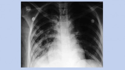 TB cases drop among the young, but racial disparities persist