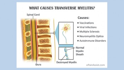 Transverse myelitis and occupational therapy