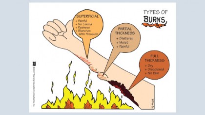 Treating minor burns