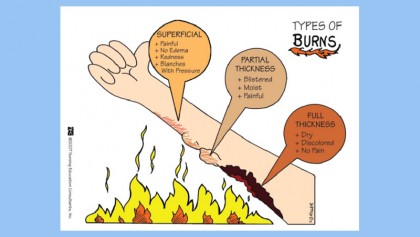 Treating minor burns