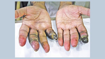 Are you suffering from ulcers on your finger?