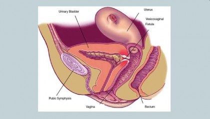 Vesico vaginal fistula may make a women miserable