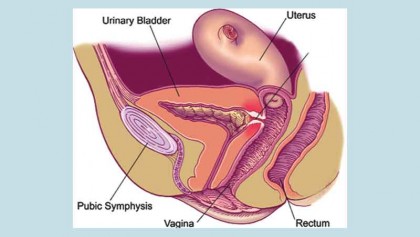 Vesico Vaginal Fistula (VVF) may make a woman miserable