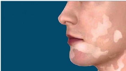 Vitiligo Facts and Myths 
