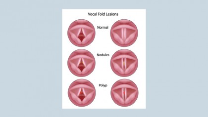 Voice disorders (Change of voice)