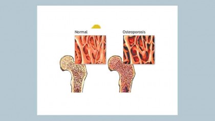 WHO criteria for diagnosis of osteoporosis