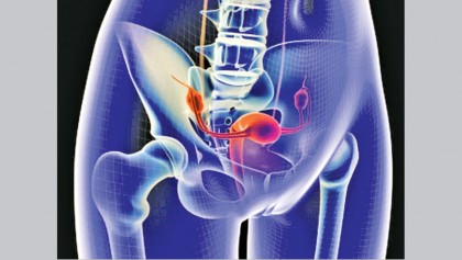 What every woman needs to know about ovarian cancer
