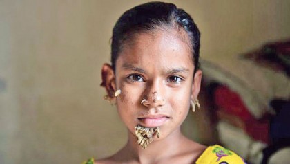 World’s first ‘tree girl’ a Bangladeshi