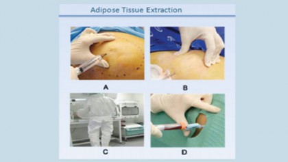 Stem cell therapy for knee injuries and arthritis