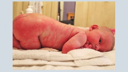 Common baby skin conditions