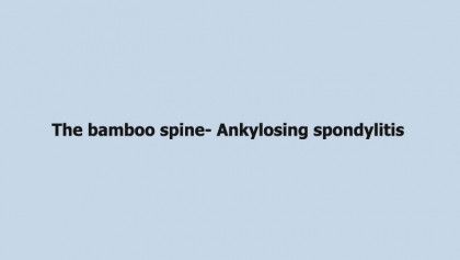The bamboo spine- Ankylosing spondylitis