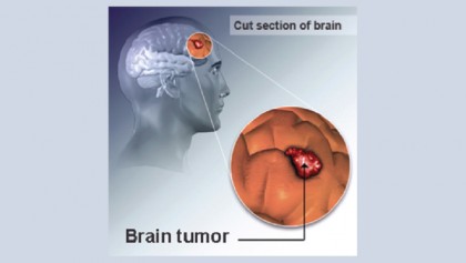 Brain tumours and brain cancer