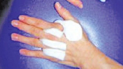 Splint for burn patient