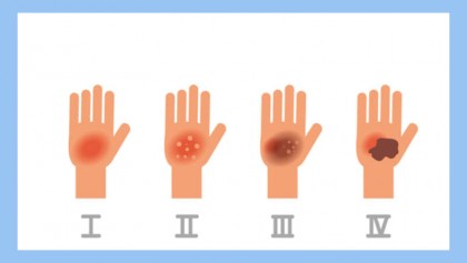 Burns: Types, treatments, and prevention