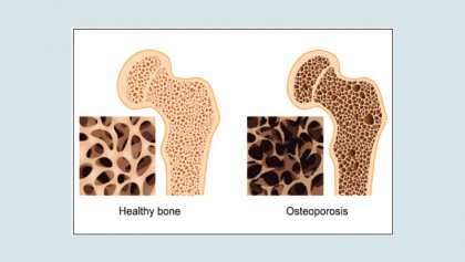 Osteoporosis: Is not a calcium deficiency disease