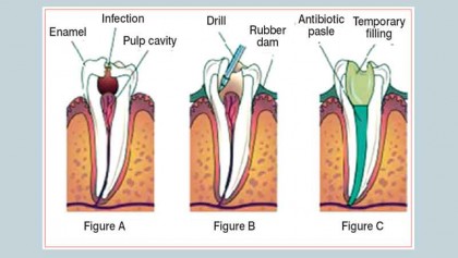 Information about root canal therapy