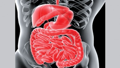 Colon polyp type may 
be key to cancer risk
