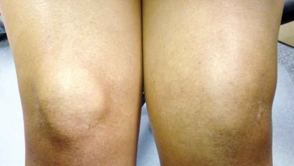 Critical clues on cartilage