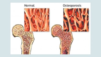 WHO criteria for diagnosis of osteoporosis